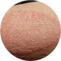 ECZEMA