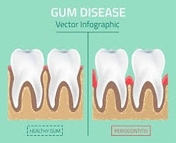 Gum Disease